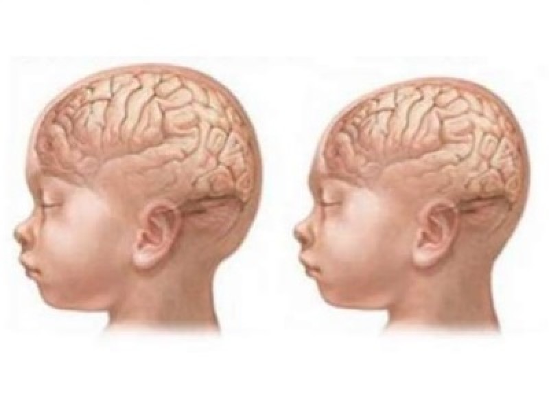 Neuropediatra diz que casos de microcefalia indicam uma nova doença